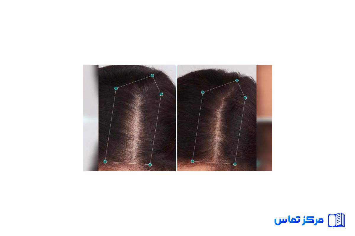 آموزش میکرواسکالپ سر ویژه تکنسین های زیبایی